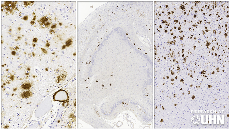 Microscopic images of brain sections showing Alzheimer plaques